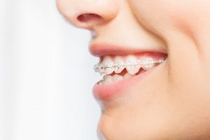 Dental Wax: Your Sidekick in Living with Braces