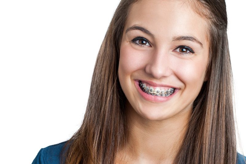 How Long Will You Be in Braces?