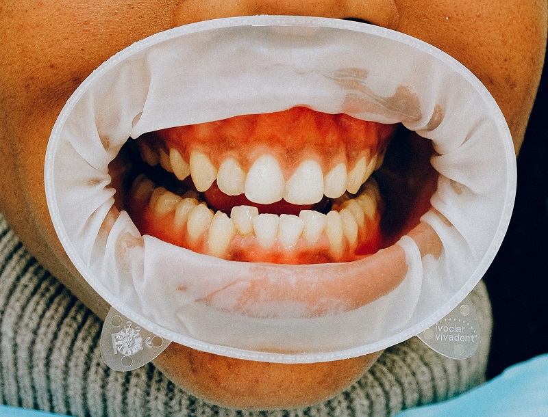 Do I Need Braces? Eng Orthodontics