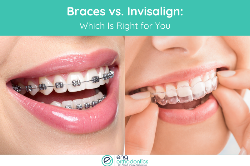 Braces vs. Invisalign Which Is Right for You