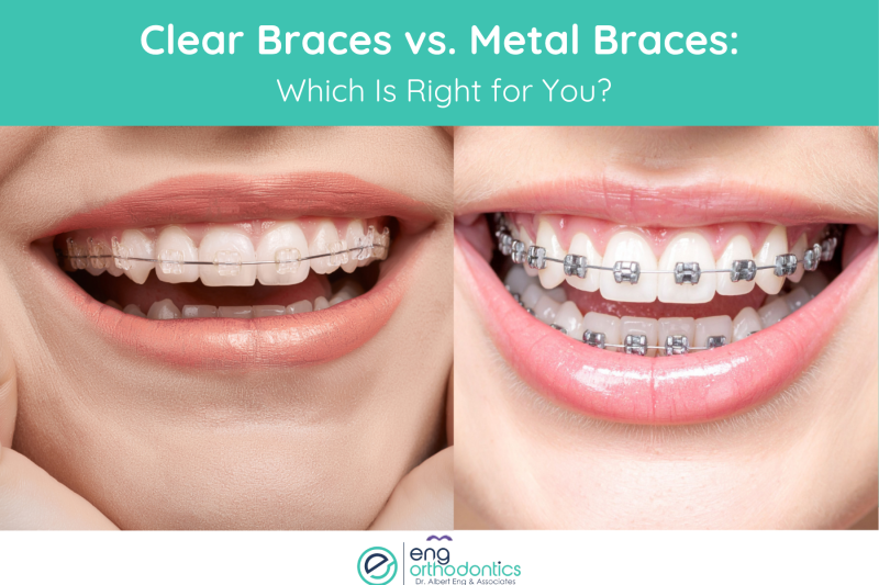 Clear Braces vs. Metal Braces Which Is Right for You